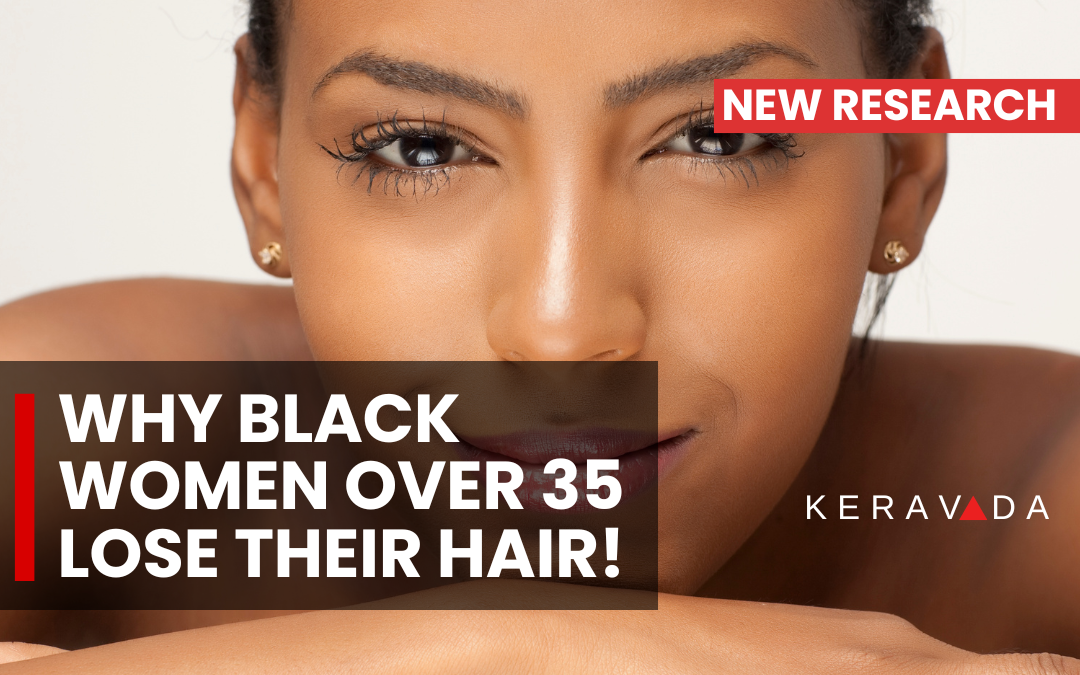 8 Surprising Reasons Why Black Women Over 35 Experience Hair Loss, How to Prevent It
